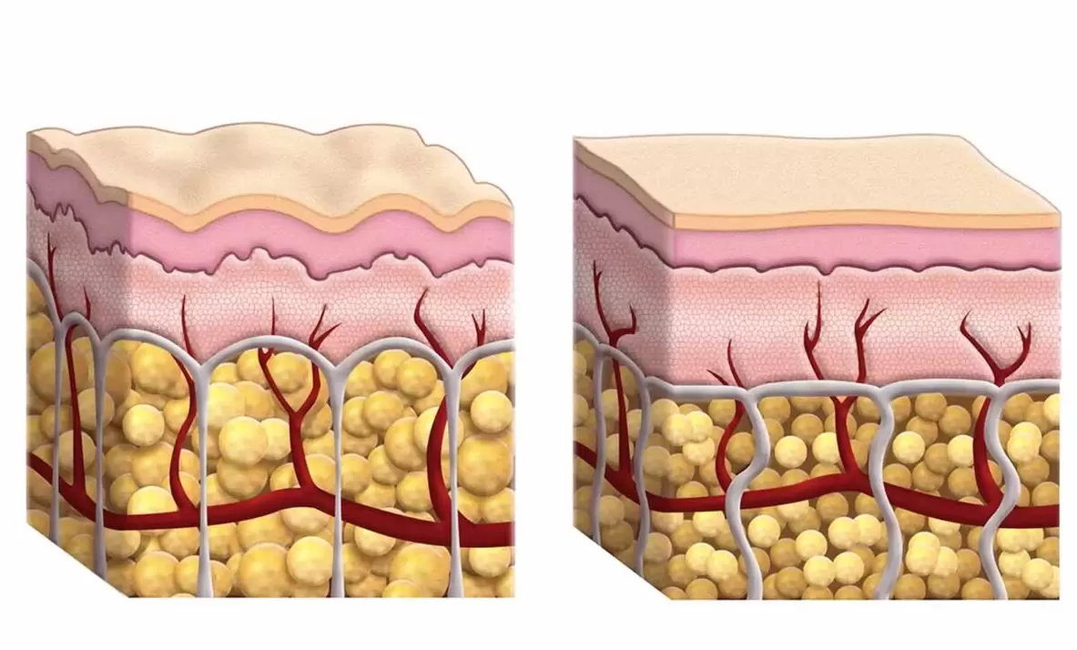 Thick cells during use of keto guru